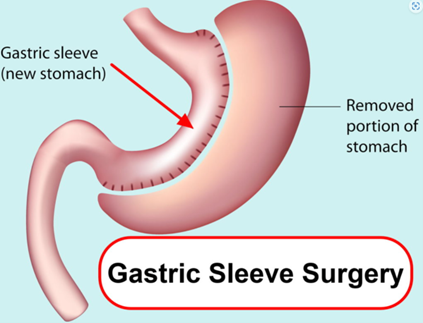 sleeve gastrctomy