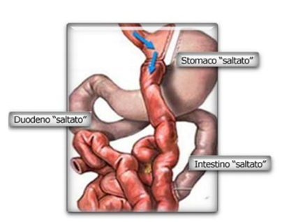 bypass gastrico